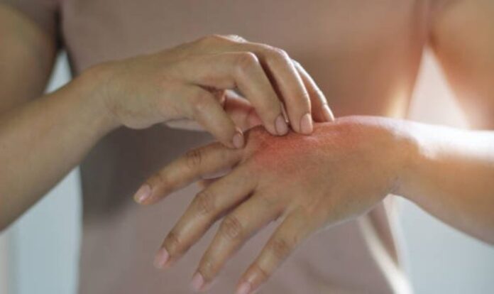 fungal-infection