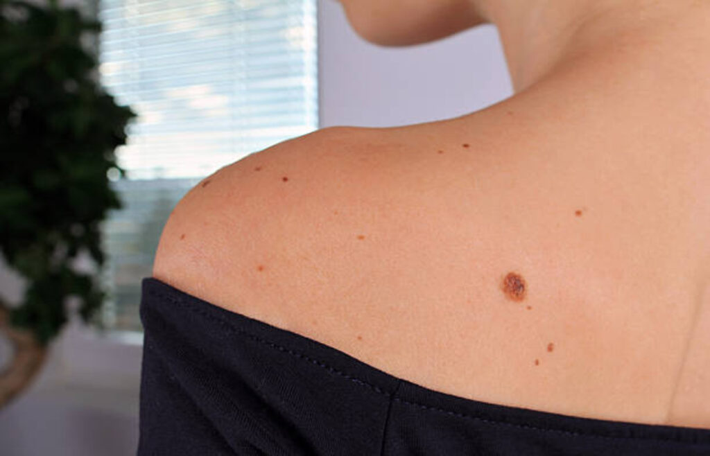 Women with mole in her shoulder